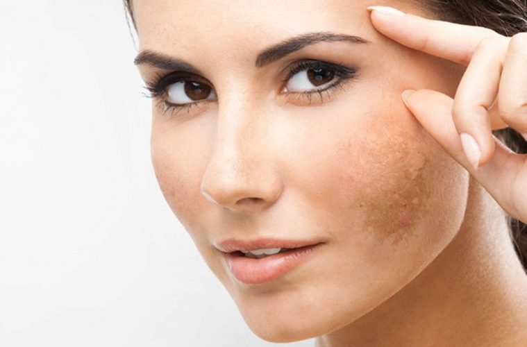 melasma-810x568-759x500 (1)
