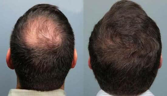 tratamento-alopecia-androgenetica-calvicie