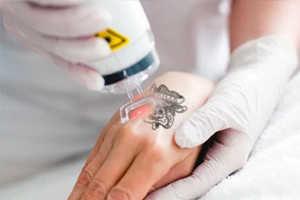remocao-tatuagem